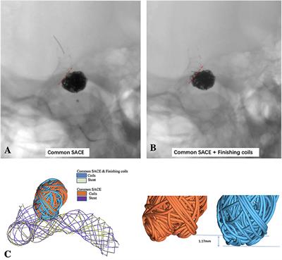 Hemodynamic Effect of the Last Finishing Coils in Packing the Aneurysm Neck